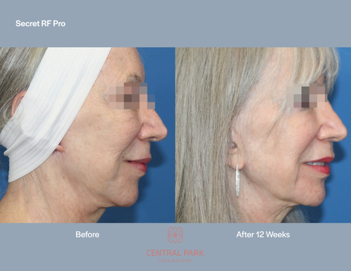 The image shows a side-by-side comparison of a person s face before and after a cosmetic procedure, specifically a nose job, with text indicating  Secret RF Pro  and a time frame for the results.