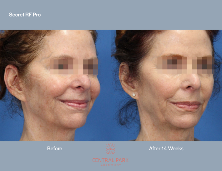 The image shows a before-and-after comparison of a person s skin, likely after a cosmetic treatment or procedure, with one side showing the initial condition and the other side showing the result after 14 weeks.