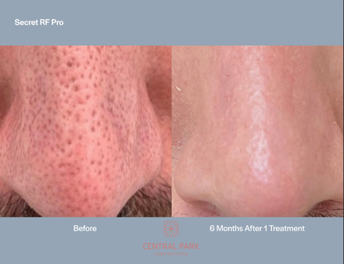 The image shows a before-and-after comparison of skin treatments, with the left side showing an enlarged pore and the right side displaying smooth, clear skin after treatment.