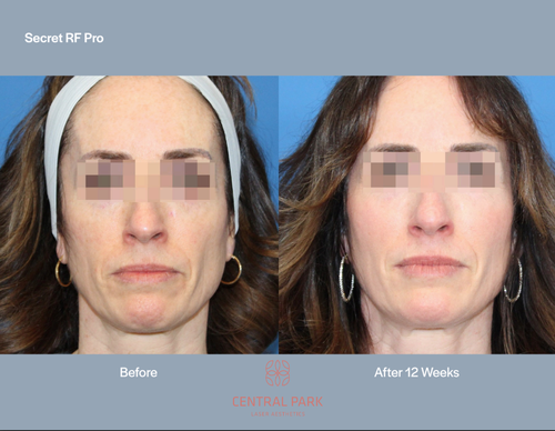 The image shows a split-screen comparison of a woman s face before and after a cosmetic procedure, with the text  SECRET RF PRO  indicating the type of treatment advertised.