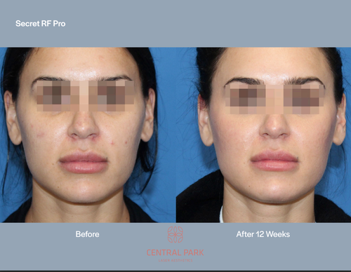 The image shows a before-and-after comparison of a person s facial appearance after undergoing a cosmetic procedure, with visible results on skin texture and contouring.