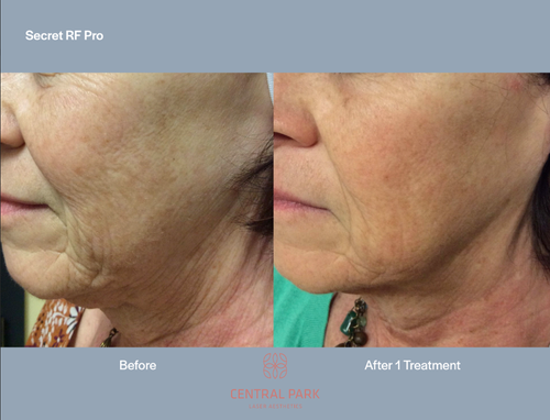 The image shows a side-by-side comparison of a person s skin before and after treatment, with text indicating  Secret Rx Pro  and  1 Treatment.