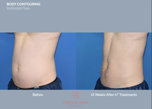 The image shows two photographs side by side of a person s midsection before and after a cosmetic procedure, specifically body contouring, as indicated by the text on the images.