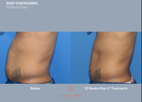 The image shows two side-by-side photos of a person's midsection before and after a cosmetic procedure, with visible text indicating '12 weeks after 4 treatments.' It highlights the results of body contouring.