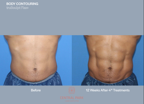 A before-and-after comparison of body contouring results with text indicating a 12-week improvement after four treatments.