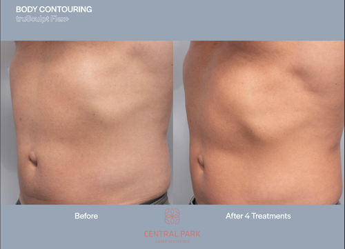 The image shows two before-and-after photos of a body contouring procedure, highlighting the results of fat removal treatments at a clinic.