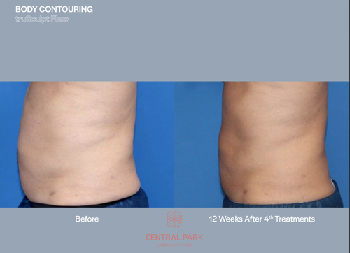 The image shows before-and-after photos of a body contouring procedure, with visible fat reduction results on a person's midsection.