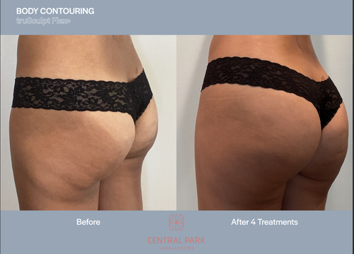 The image displays a before-and-after comparison of body contouring treatments, featuring two photos side by side of a person's lower torso before and after treatment, with visible differences highlighting the results of the cosmetic procedure.