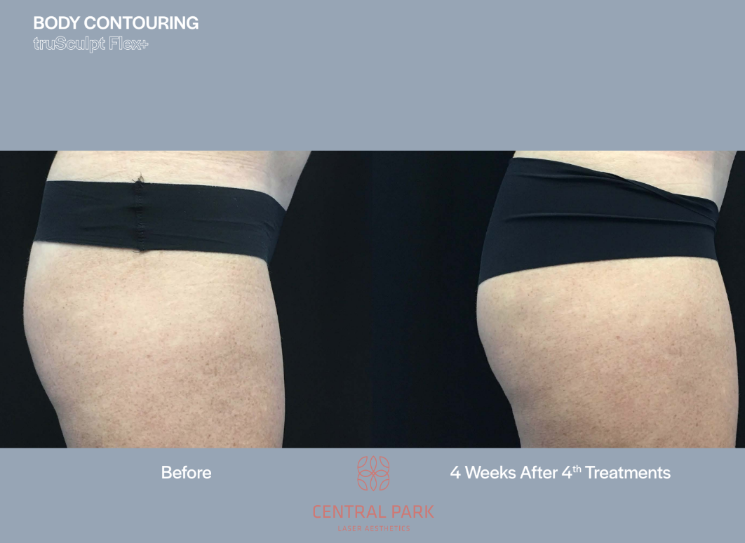 The image shows before-and-after photos of body contouring treatments, highlighting the results achieved through cosmetic procedures.