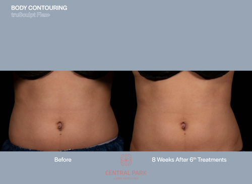 The image shows a before-and-after comparison of body contouring results, featuring two photographs side by side of an individual s midsection with text indicating a six-week improvement after six treatments.