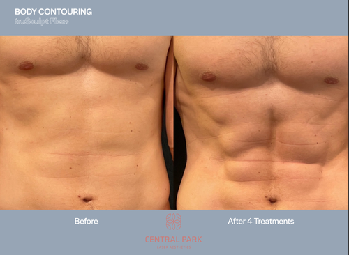 The image shows a comparison between a person s natural body shape and the results of a cosmetic procedure, specifically a body contouring treatment. It features a before-and-after view of a man s abdomen, highlighting the difference in appearance after the treatment.