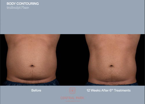 The image shows two photos side by side of a person s midsection before and after body contouring, with text indicating a 2-week treatment period.