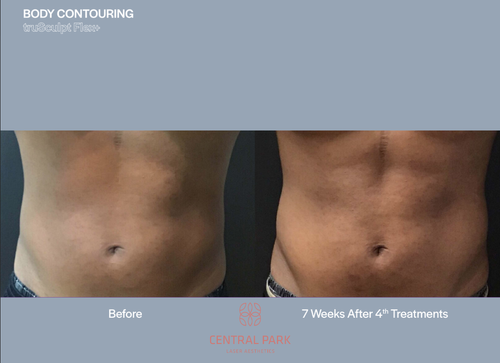 The image shows two before-and-after photos of a person s body after cosmetic procedures, likely at a clinic specializing in body contouring.
