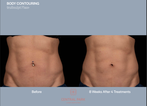 The image shows a before-and-after comparison of body contouring results with a focus on abdominal area enhancement, featuring a side view of a person's torso with visible muscle definition and a contrasting post-treatment appearance emphasizing fat reduction and contouring effect.
