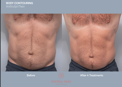 The image shows two side-by-side photos of a person's torso before and after a cosmetic treatment, likely body contouring, with text indicating 'BEFORE TREATMENTS' and 'AFTER TREATMENTS.