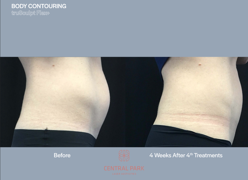 The image displays a before-and-after comparison of a body contouring procedure, featuring two photographs side by side with text indicating a transformation after 4 weeks of treatments at Central Park.