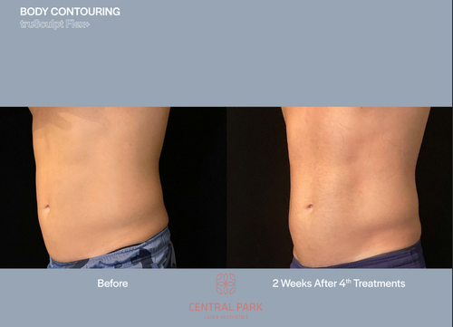 The image shows a split-screen photograph of a person's midsection before and after a cosmetic procedure, with text indicating 'BEFORE' on the left and 'AFTER' on the right, highlighting body contouring results.