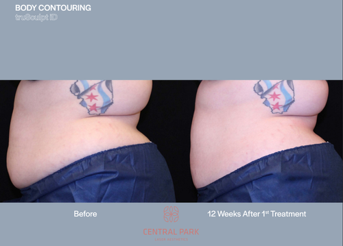 The image shows a before-and-after comparison of body contouring, featuring a person's midsection with visible tattoo artistry on their skin, highlighting the results of a cosmetic procedure.