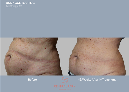 The image shows two before-and-after photos of body contouring treatments, displaying the results of a procedure for a client, with text indicating 10 weeks after treatment.