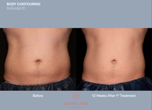 The image shows a before-and-after comparison of body contouring results, with two photographs side by side, one showing a person's abdomen with visible fat and skin irregularities, and the other showing the same area after treatment, appearing smoother and more defined.