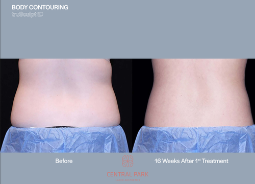 The image shows a before-and-after comparison of body contouring results, featuring two photos side by side: one showing a person's abdomen with visible fat deposits, and the other displaying a more sculpted and toned appearance after treatment, with a focus on the waistline area.