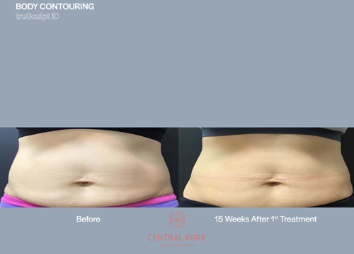 The image displays two side-by-side before-and-after photographs of a person's abdomen after body contouring, showcasing the results of a treatment that has reduced the appearance of fat or skin irregularities.