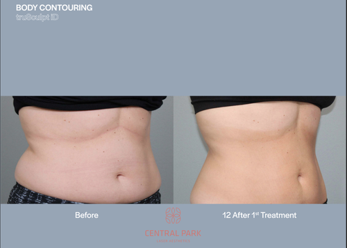 The image displays a before-and-after comparison of body contouring results, showing a person's abdomen with visible fat reduction after treatment.
