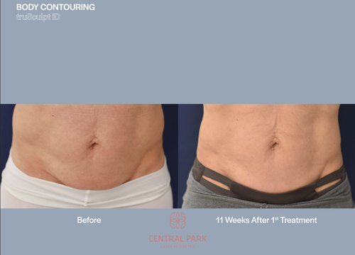The image shows two before-and-after photographs of a body contouring treatment, with one side showing a person's abdomen before the procedure and the other after, highlighting the results of the treatment.