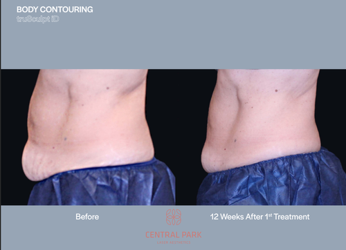 The image shows a side-by-side comparison of a person's body before and after a cosmetic procedure, specifically a tummy tuck, as indicated by the text 'Body Contouring' in the top left corner.