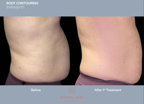 The image shows two side-by-side photos of a person's body before and after a cosmetic treatment, specifically a tummy tuck, with text indicating 'Body Contouring' and 'Treatment Before 4D.
