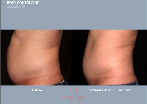 The image shows a before-and-after comparison of body contouring, with two views of a person's torso, one showing a bulging stomach and the other a significantly slimmed waistline after treatment.