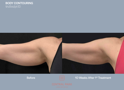 The image displays a side-by-side comparison of a person's arm before and after a 10-week treatment, highlighting the results of body contouring.