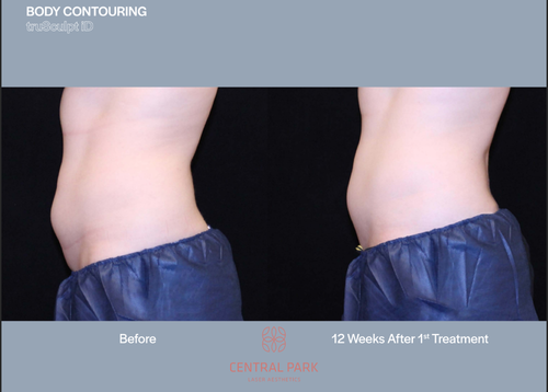 The image shows a before-and-after comparison of body contouring results with text indicating a 12-week treatment period.