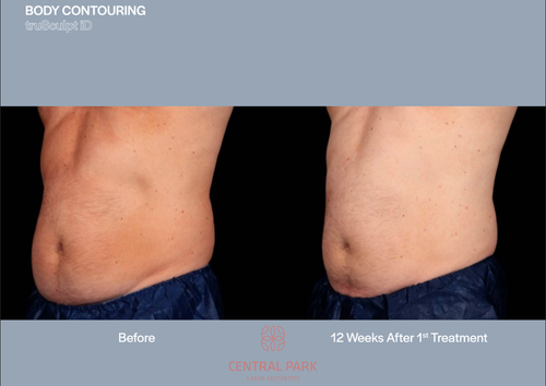 The image shows a before-and-after comparison of a body contouring treatment, with two photos side by side: one showing a person's abdomen before treatment, which appears to have excess fat, and another showing the same area after treatment, looking more defined and toned.
