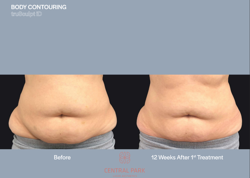 The image displays a before-and-after comparison of body contouring procedures, showcasing the results of a 12-week treatment with images of a person's abdomen before and after the procedure.