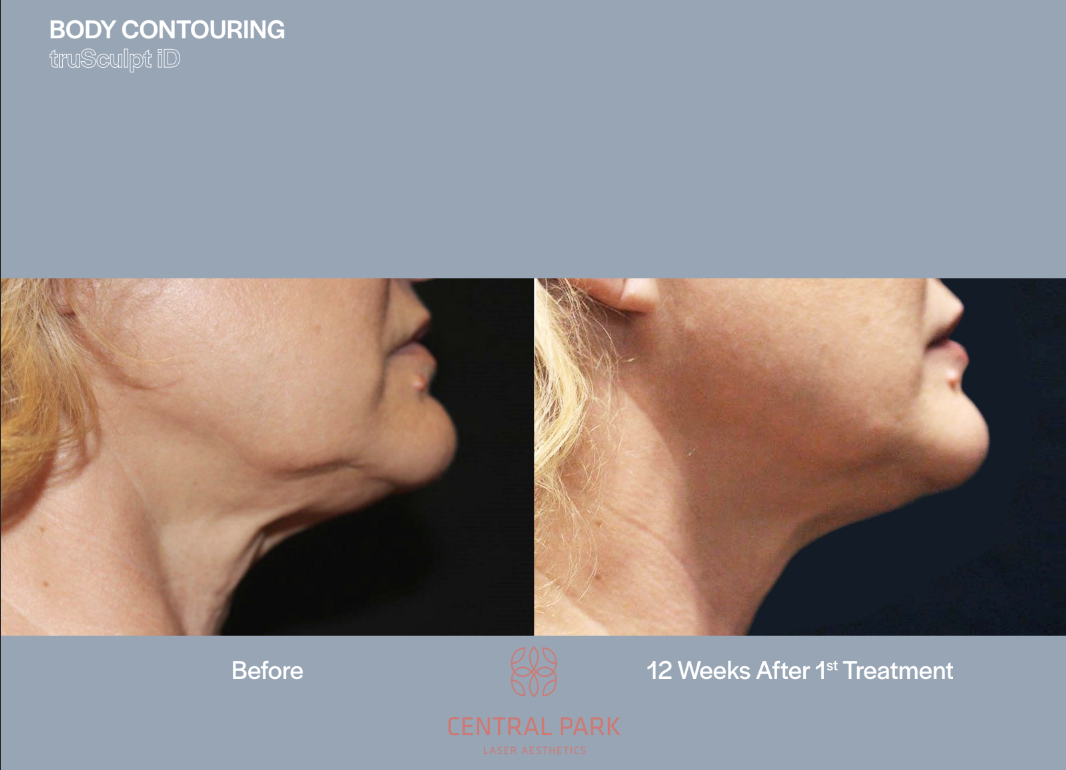 The image displays a split-screen comparison of a person's face before and after cosmetic surgery, with text indicating a 12-week treatment process. It shows a side view of facial contouring results, highlighting the difference in appearance between the two stages.