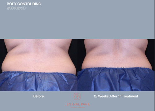 The image shows a before-and-after comparison of body contouring results, with two photos side by side: one showing a person's back profile before treatment, and another after 12 weeks of treatment, highlighting the improvement in the waistline area.