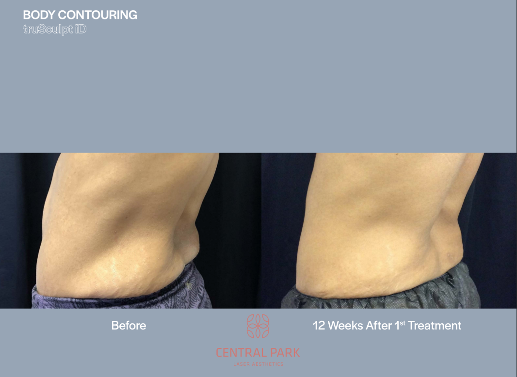 The image shows two photographs side by side of a person's abdomen before and after a cosmetic procedure, specifically body contouring, with the text 'BODY CONTOURING' visible above the images.