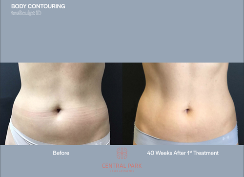 The image shows a side-by-side comparison of a person's body before and after cosmetic treatment, with the left side showing a fuller appearance and the right side showing a slimmer waistline.