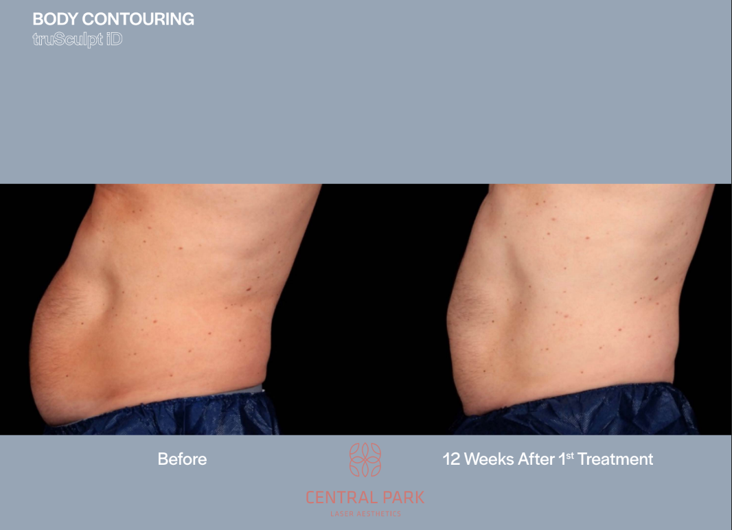 The image shows two photographs side by side of a person's torso before and after body contouring treatment, highlighting the results of the procedure.