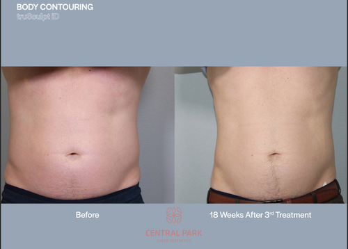 The image shows two before-and-after photographs of a person's abdominal area after body contouring, with one photo showing the result and the other showing the treatment process.