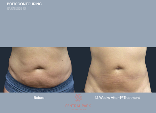 The image shows two before-and-after photos of body contouring results, highlighting the transformation achieved through a cosmetic procedure.