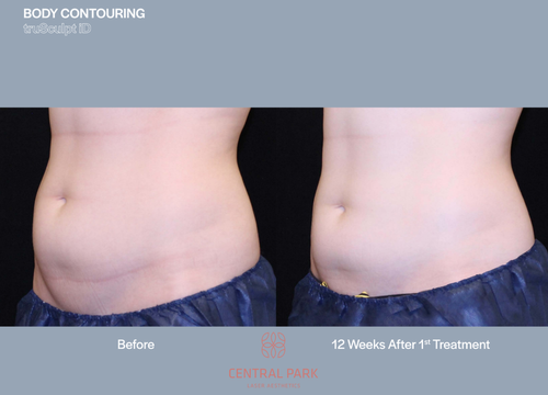 The image shows a split comparison between a person's body before and after cosmetic treatment, specifically body contouring, with a focus on abdominal area improvement.